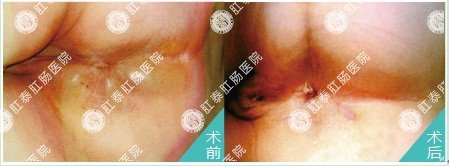 肛肠吻合器技术治疗肛周脓肿对比图