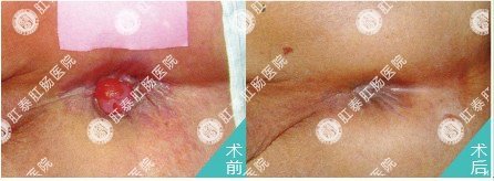 肛肠吻合器技术治疗痔疮引起的肛门瘙痒